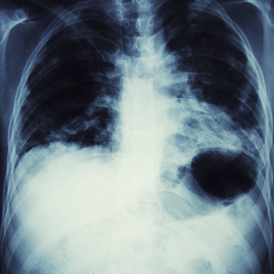 Nanobubbles May Offer Us a New Cure for Lung Cancer