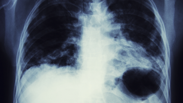 Nanobubbles May Offer Us a New Cure for Lung Cancer