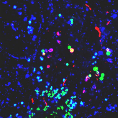 Nanoplastics Promote Conditions for Parkinson’s Across Various Lab Models